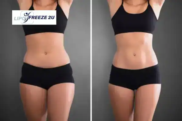 How Can LIPO FREEZE 2U Support Your Post-Pregnancy Body Recovery Bridgnorth?