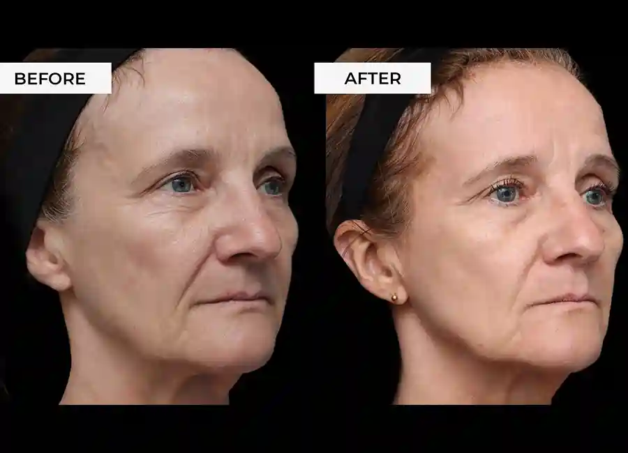 How Many RF Microneedling Sessions Will You Need to See a Difference Bridgnorth?