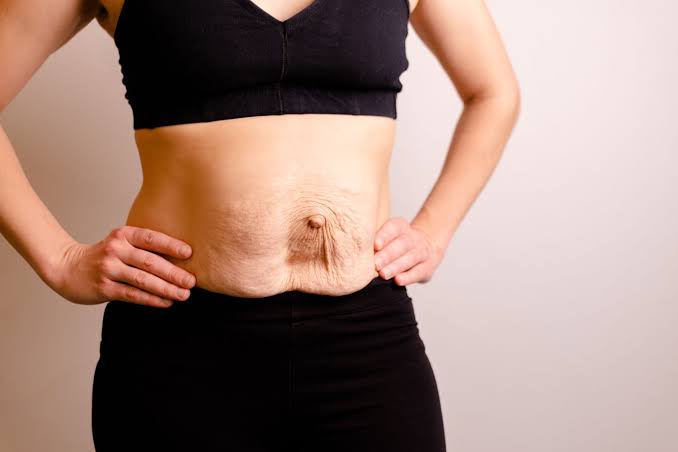 Is Surgery Really the Only Way to Repair Diastasis Recti Bridgnorth?
