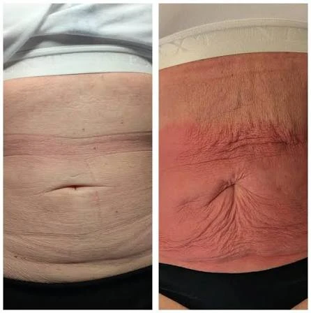How Does RF Microneedling Improve Crepey, Thin and Uneven Skin Texture Bridgnorth?