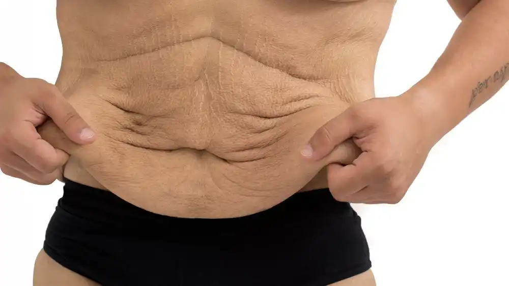 Why Does Weight Loss Medication Leave Some People With Loose or Sagging Skin Bridgnorth?